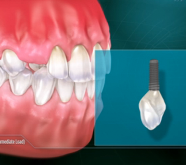 implant-leftside.png