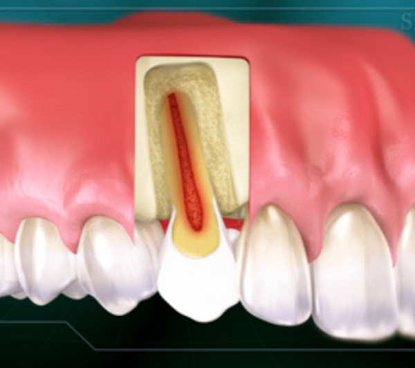 root canal