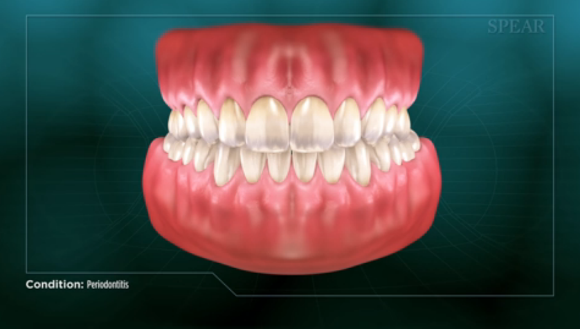 periodontitis.png